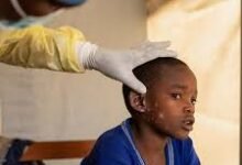 • A child suffering from Mpox in the Democratic Republic of Congo