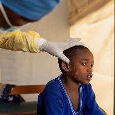 • A child suffering from Mpox in the Democratic Republic of Congo